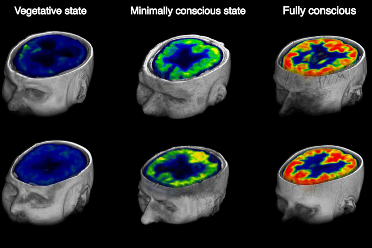 coma consciousness metabolism conscious2